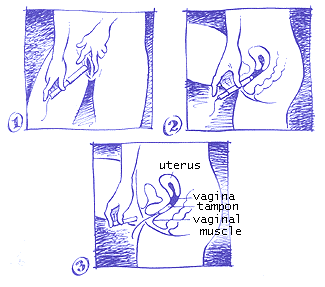 het inbrengen van een tampon, met inbrenghuls